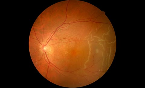 Fundus photography showing a retinal detachment