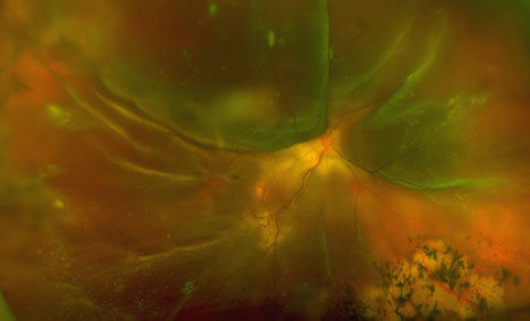 Image d’un décollement de rétine en retinographie grand champ