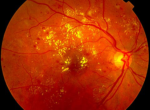 Retinophotography of diabetic retinopathy