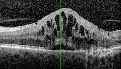 Macular Oedema in OCT