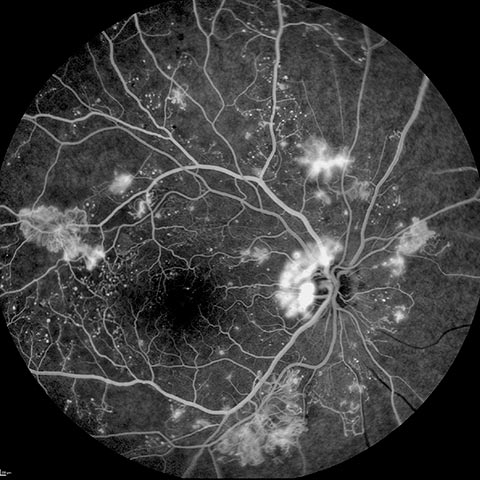 Angiography of a proliferating diabetic angiography