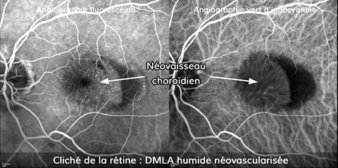 Cliché de la rétine : DMLA humide néovascularisée
