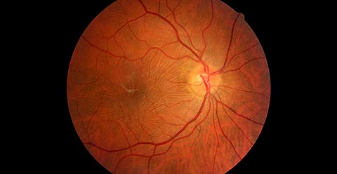 Epiretinal membrane with retinal creases