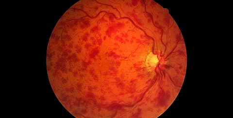 Fundus photography: CRVO with numerous retinal haemorrhages