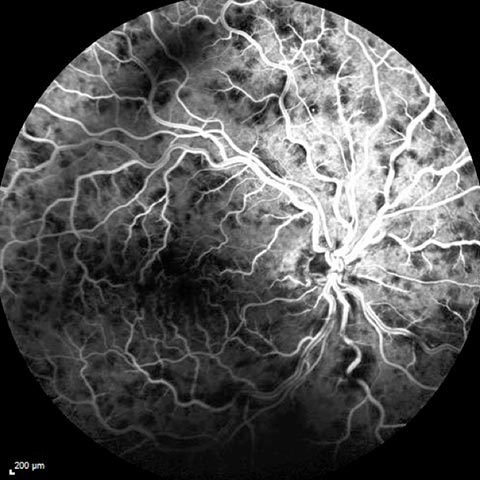 Fluorescein Angiography photography: dilated and tortuous veins